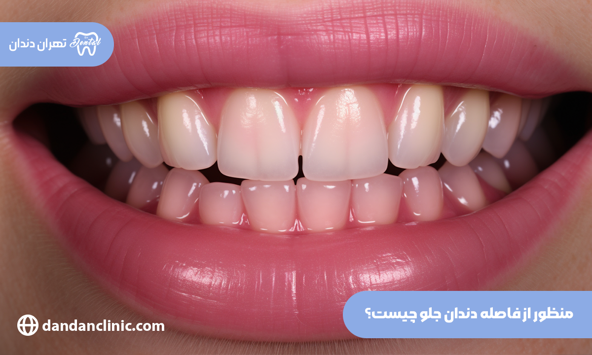بستن فاصله دندان با کامپوزیت